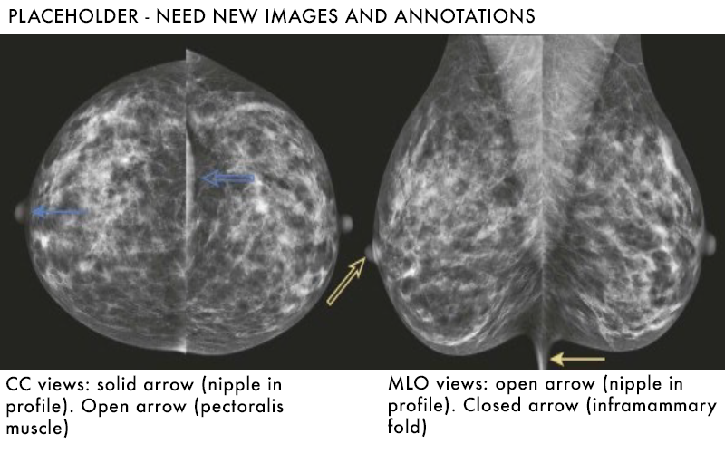 Mammography placeholder - Basics of interpreting mammograms